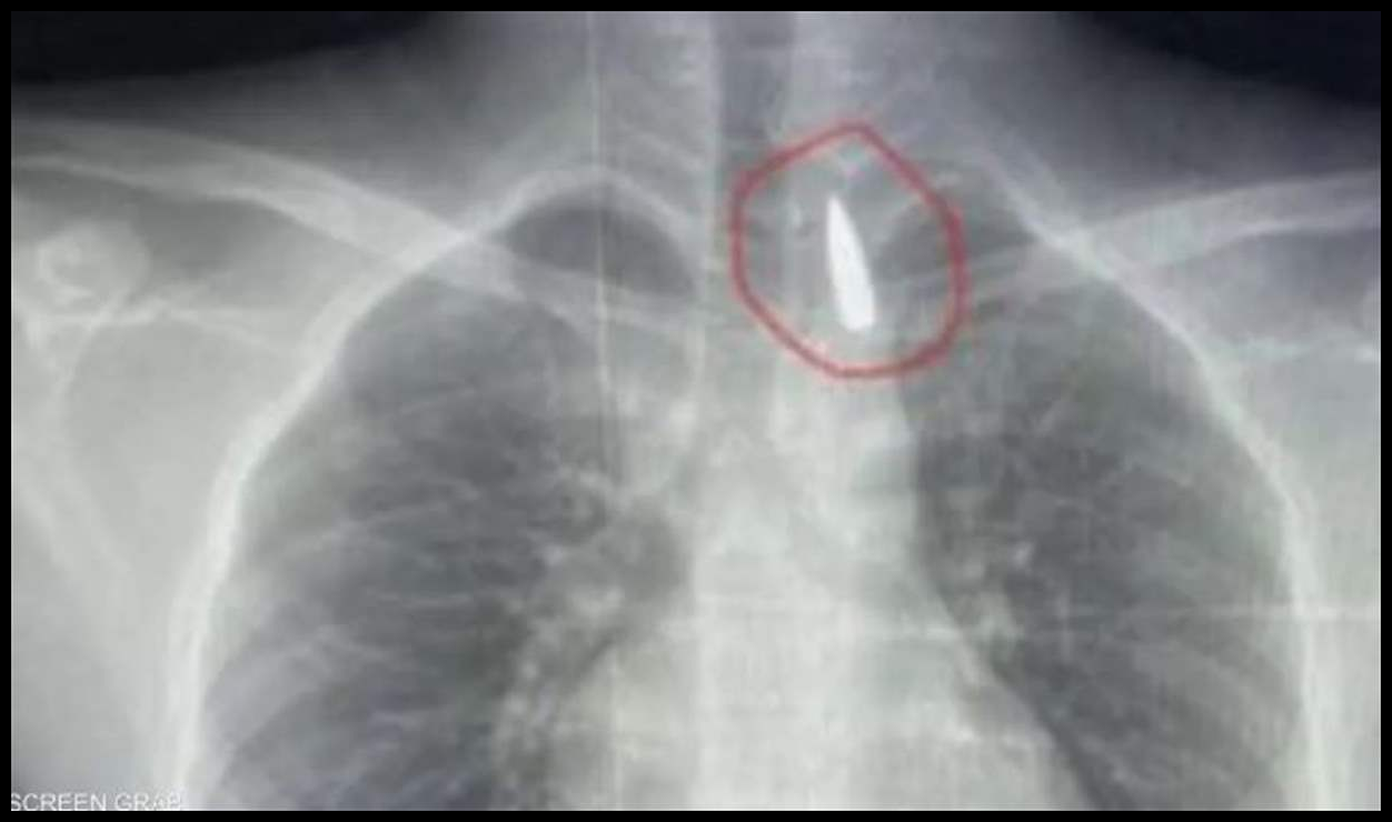 جراحة معقدة.. إنقاذ حياة طفل من غزة مصاب بمقذوف في صدره 1 Doc P 547644 638970920506796634